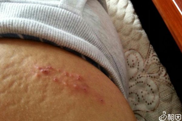 生殖器疱疹是由单纯疱疹病毒感染而引起的性传播性疾病,从理论上而言