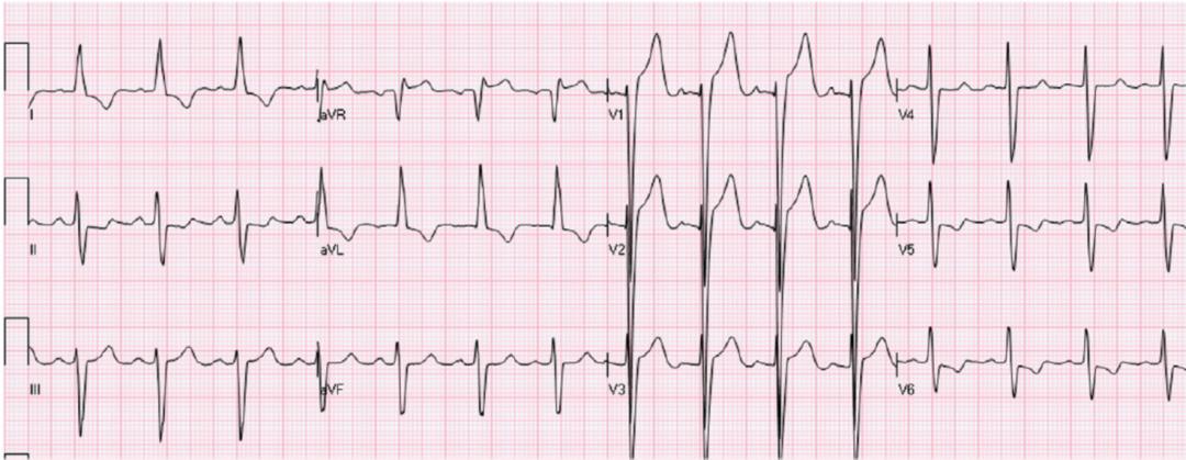 st段抬高不一定是心梗这8张心电图必须鉴别