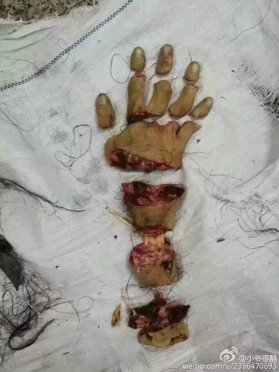 手断成这样还能接回来,医生太牛了!