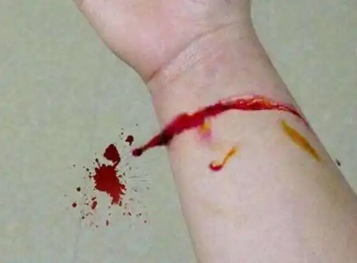 爱惜身体珍爱生命浅说割腕的危害性