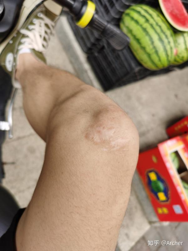 参军我这个疤痕能不能通过体检