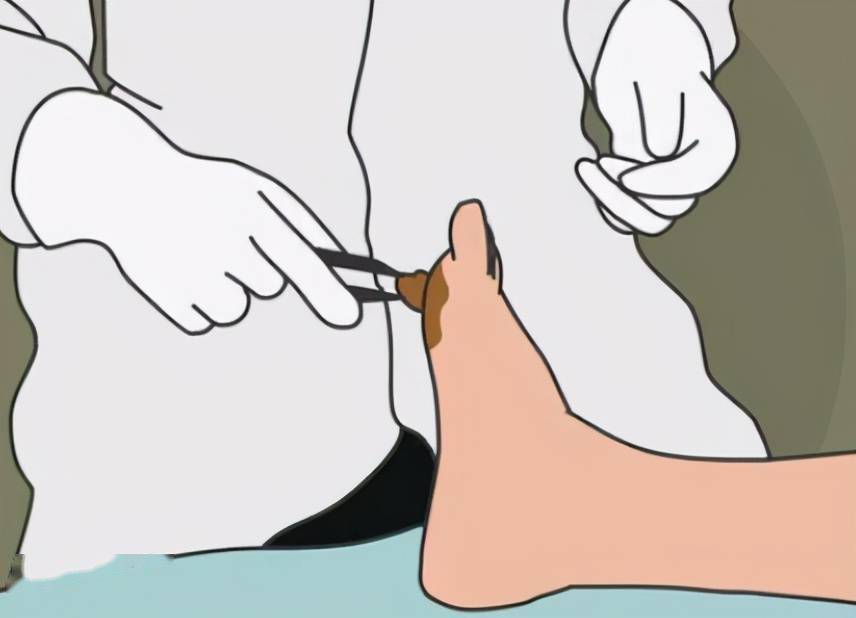 糖尿病病友请留心小小溃疡也可能引发截肢做对5件事很关键