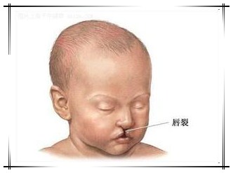 遗憾!安真四维彩超筛查出一例胎宝宝"兔唇"