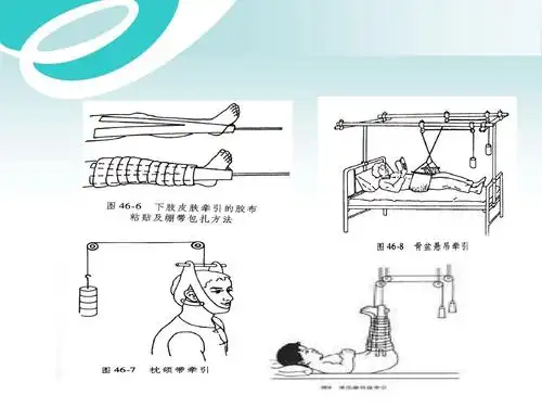 骨科牵引术ppt