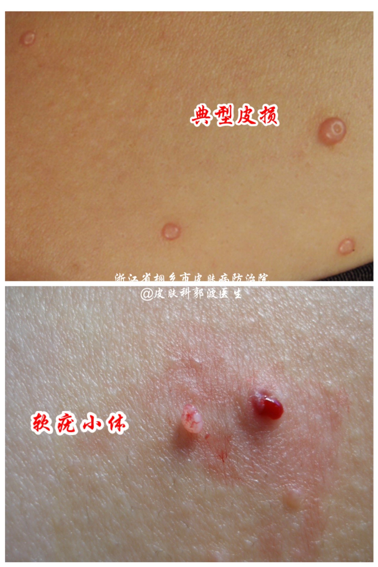 传染性软疣_疾病介绍_治疗方法_传染 - 好大夫在线