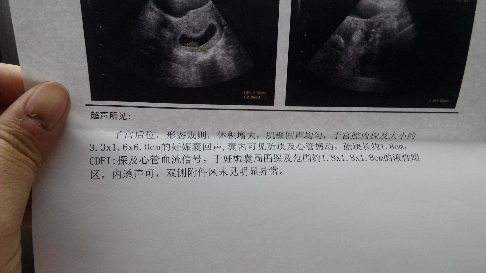 八周比超孕囊3.3*1.6*6.0cm正常吗