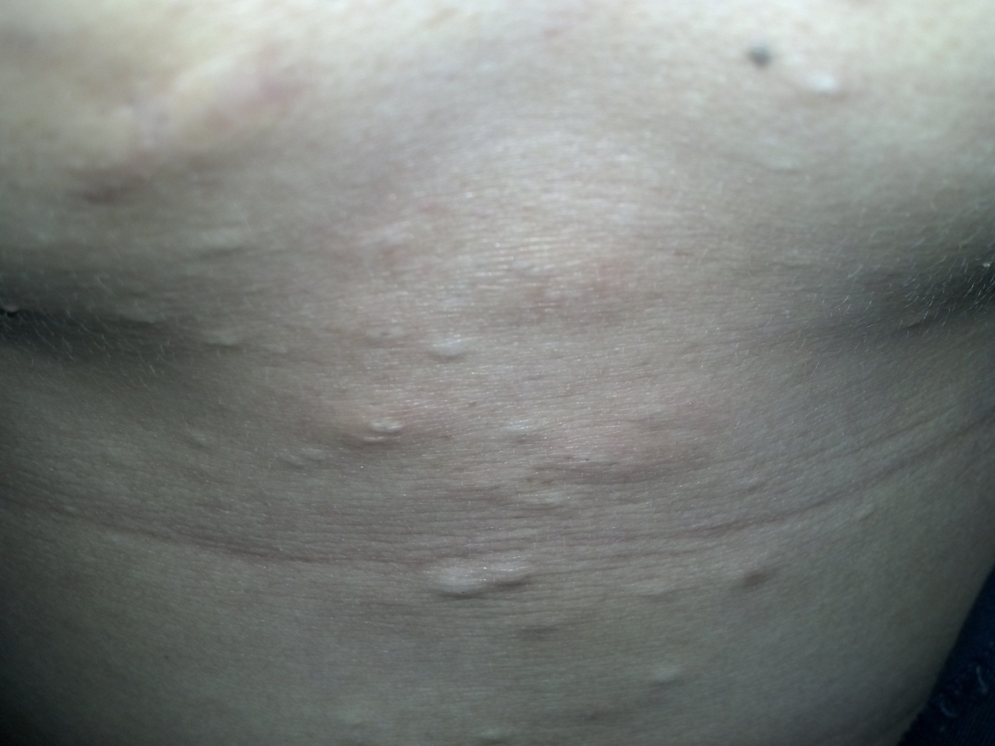 回答: 病情分析: 你好,根据你的症状需要考虑是多发性脂肪瘤