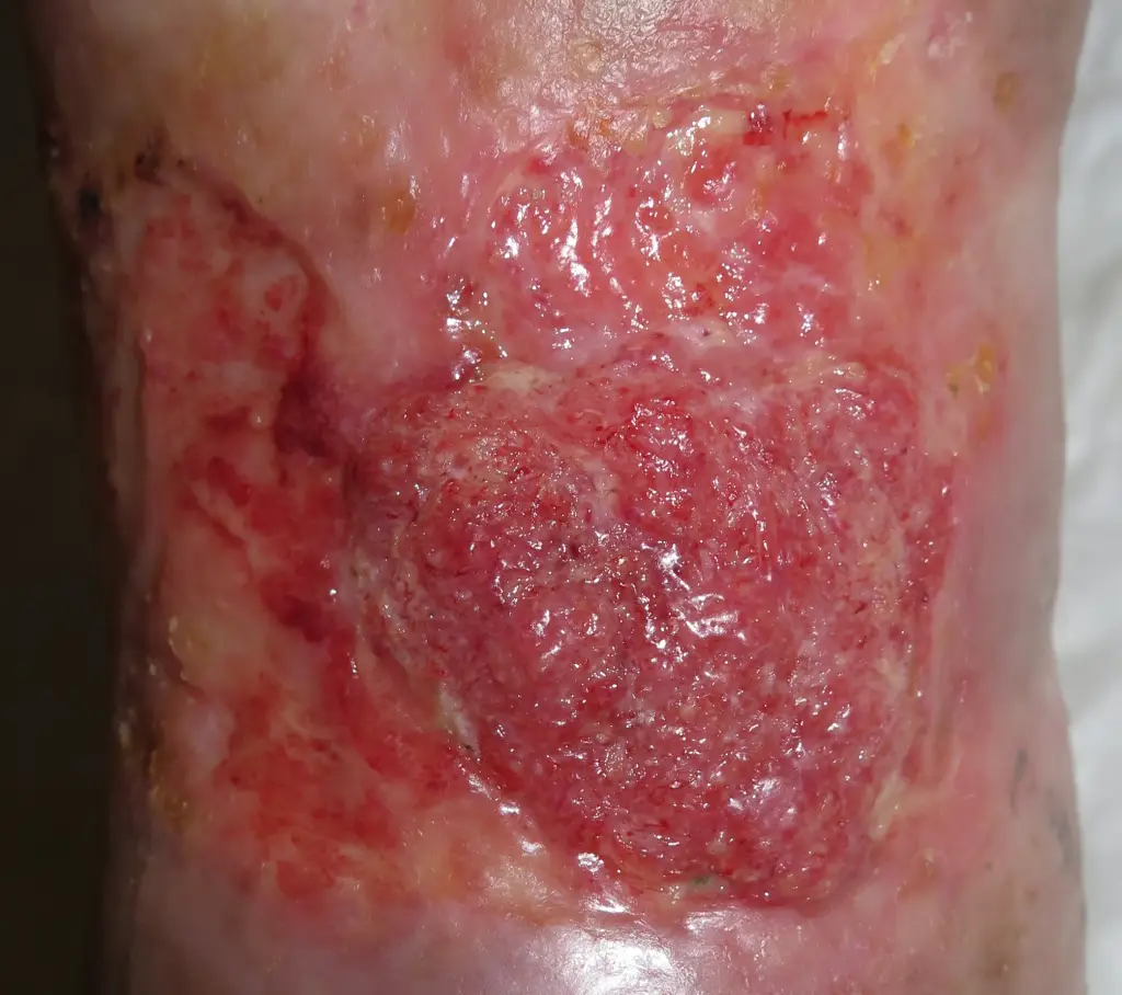 肉芽组织过度增生当伤口床被过度激活