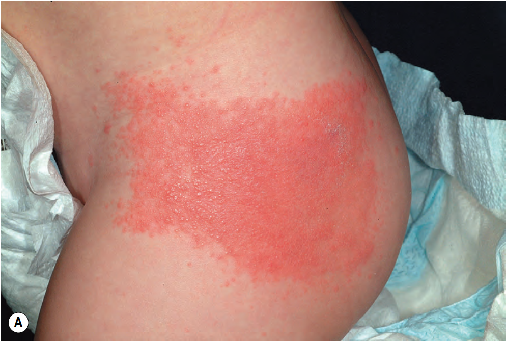 接触性皮炎有什么主要症状?