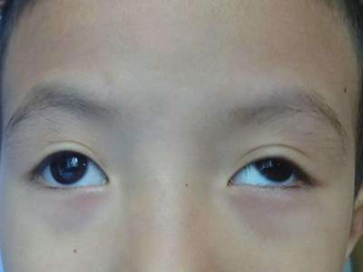 恒定性外斜视左眼球变形向左上方偏斜图