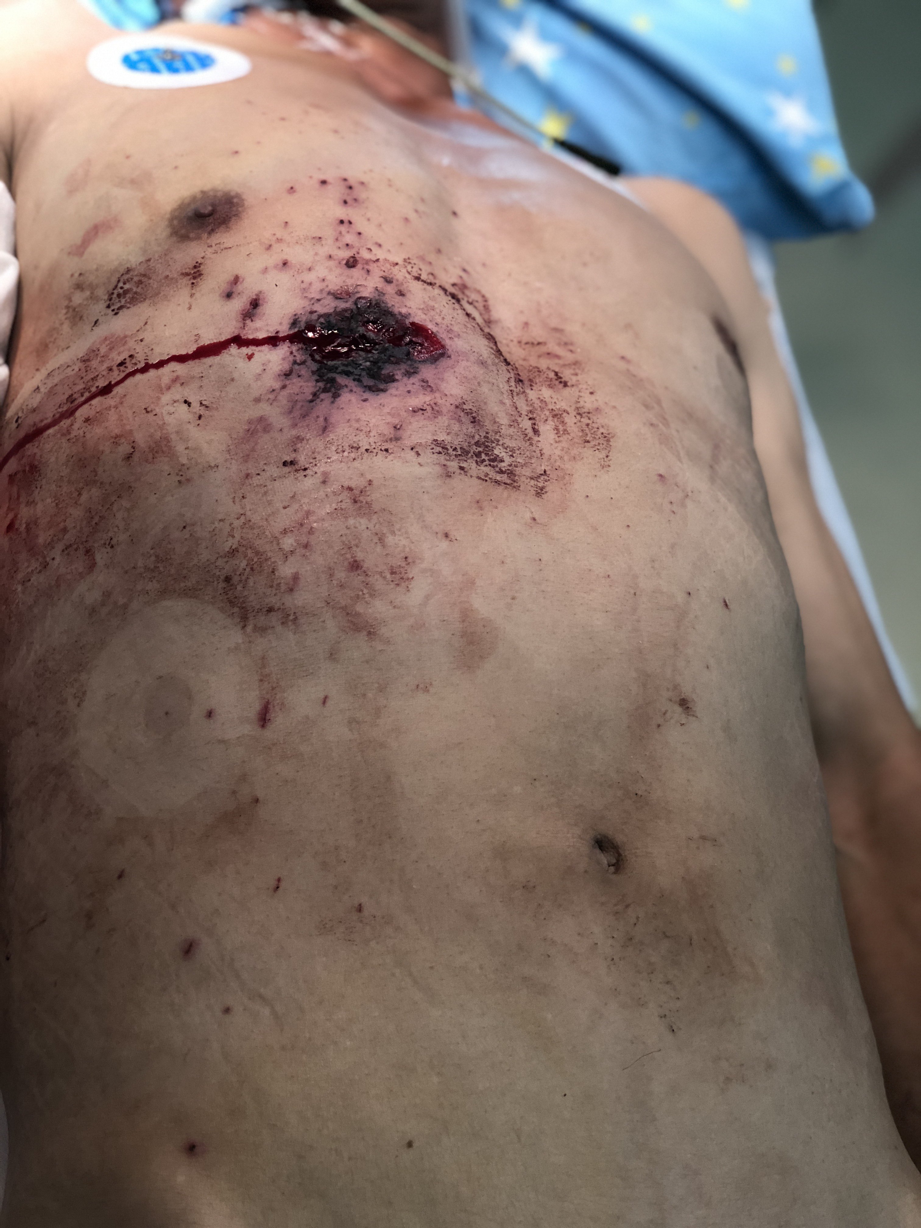 枪击伤:尽量而不强求彻底取除子弹,止住血,通畅引流 - 好大夫在线