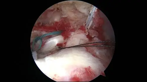 冈上肌腱u型撕裂镜下修补,lhbt重建cable术