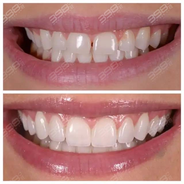 get这四种美牙方法牙齿变白不是梦