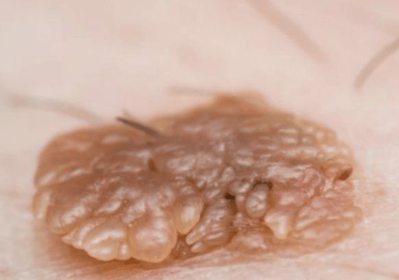 男性尖锐早期症状图片6