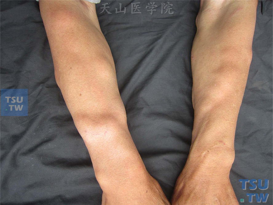 良性肿瘤:脂肪瘤(lipoma)症状表现