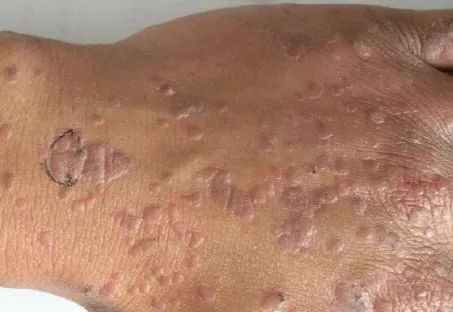 皮肤长了小肉粒,竟是hpv感染?甚至会癌变!