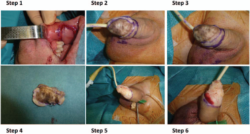 大致的手术步骤