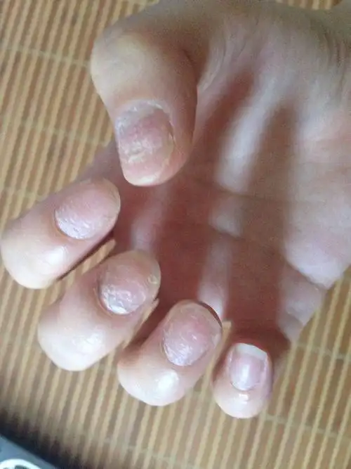 上肢 手 指甲异常 病情描述及疑问:指甲像褪皮一样 一开始是凹点后来