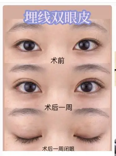 做双眼埋线双眼皮的图片