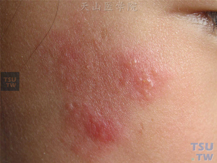 单纯疱疹(herpes simplex)症状表现