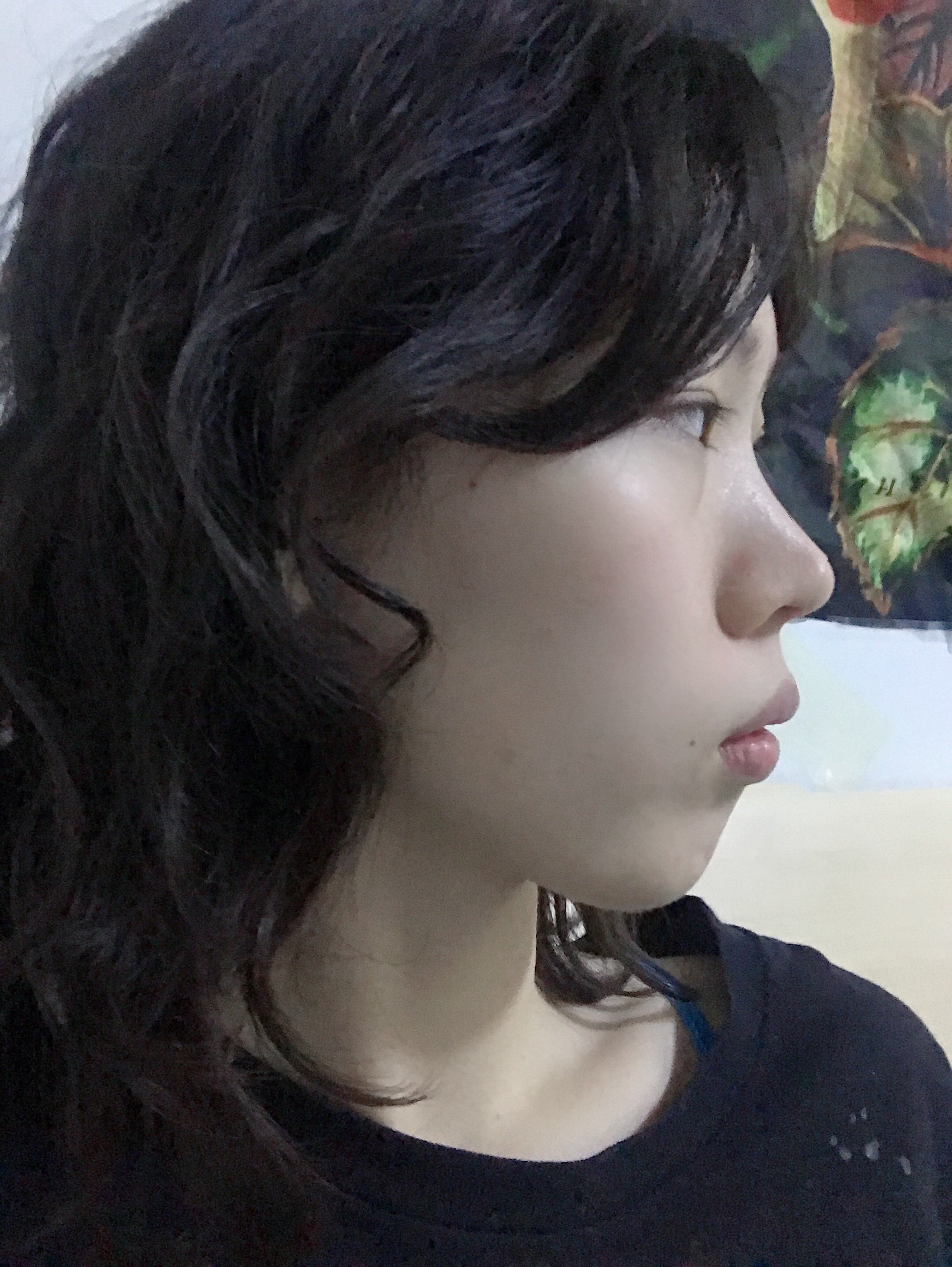 请问我是骨性嘴凸吗一定要正颌手术调整吗