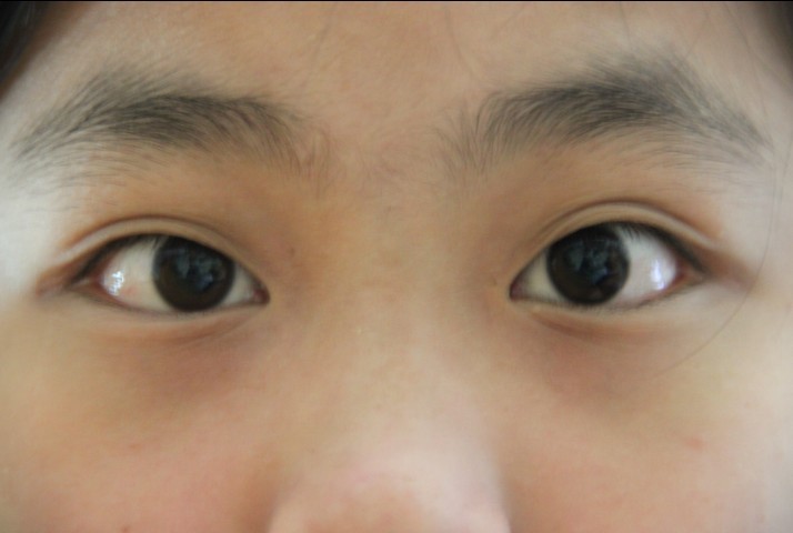 我这斗鸡眼能好吗,不动手术,我还近视400,怎么办?