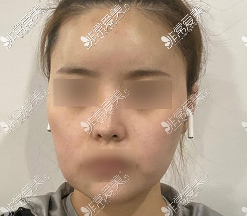 脂肪填充失败的案例vs脂肪填充成功案例看完惊呆