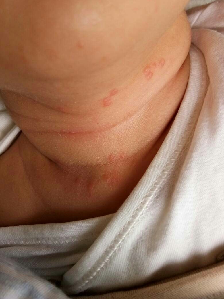 请问这是痱子,还是湿疹,该怎么办?_百度知道