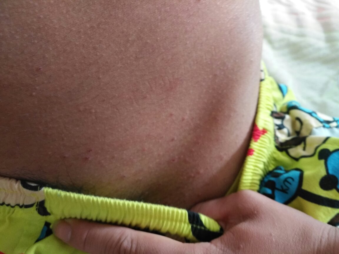 肚子下面都痘痘,还很痒