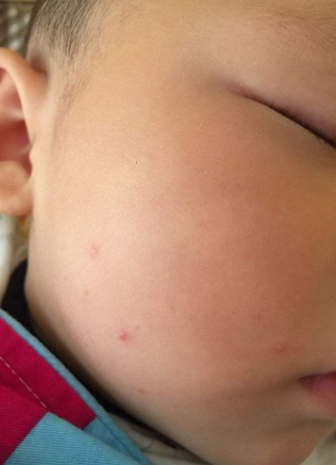 儿童软疣图片 (20)_有来医生