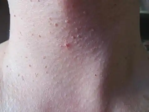 脖子 腋下等处长的 小肉粒 是啥 会影响健康吗 好多人不清楚