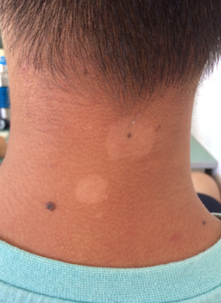 汗斑早期症状图片58