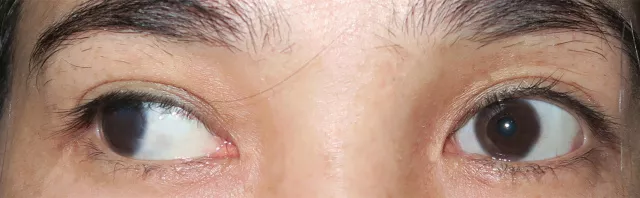 惊!成年后的她突然斜视,原因可能是