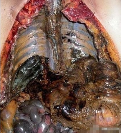 我从网上截的一个抽烟者肺部图片 想知道一下这是什么病 黑成这个样子