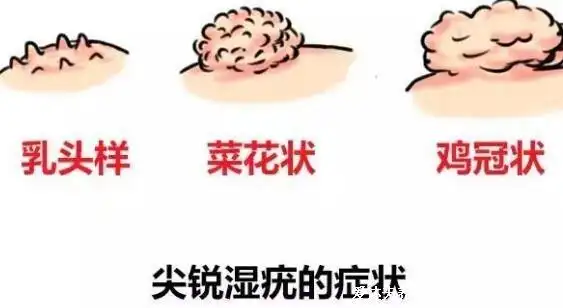 女士尖锐湿疹样子图片,初起淡红色柔软丘疹增多融合(平均潜伏期2-3月)