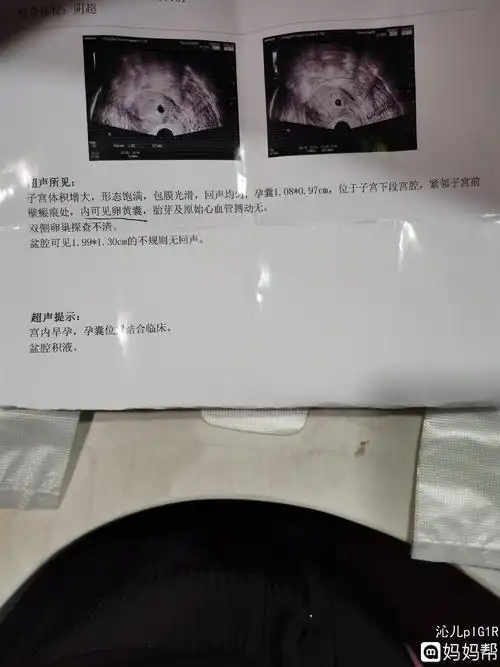 吉日良辰!怀孕40天孕囊大小标准值"兴致勃勃"-第2张图片-晴天助孕