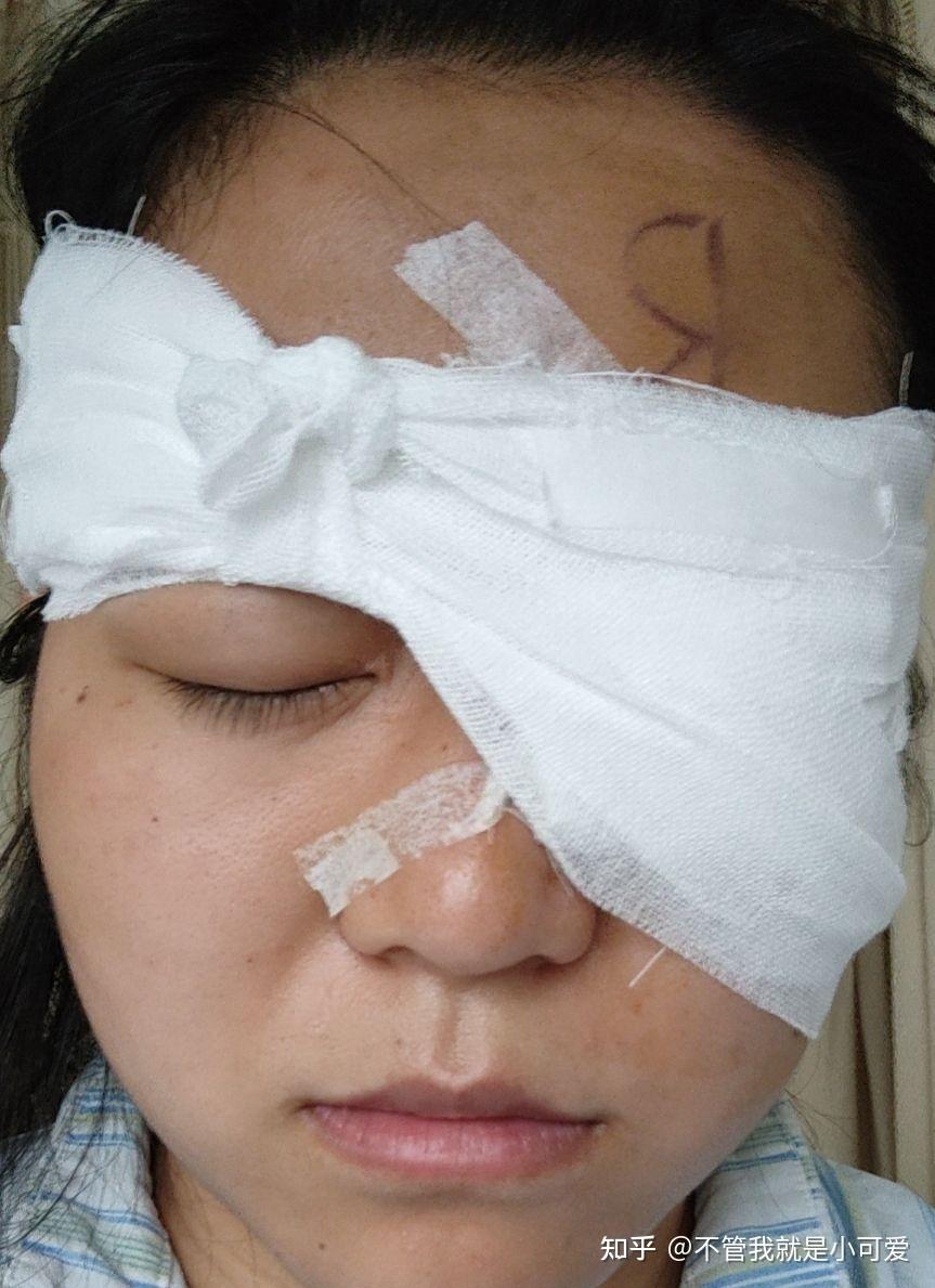 倒睫睑内倒翻造成结膜炎开刀手术