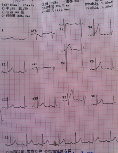 电轴轻度右偏都是正常人可以出现,电轴右偏是与个人的肥胖程度有关系