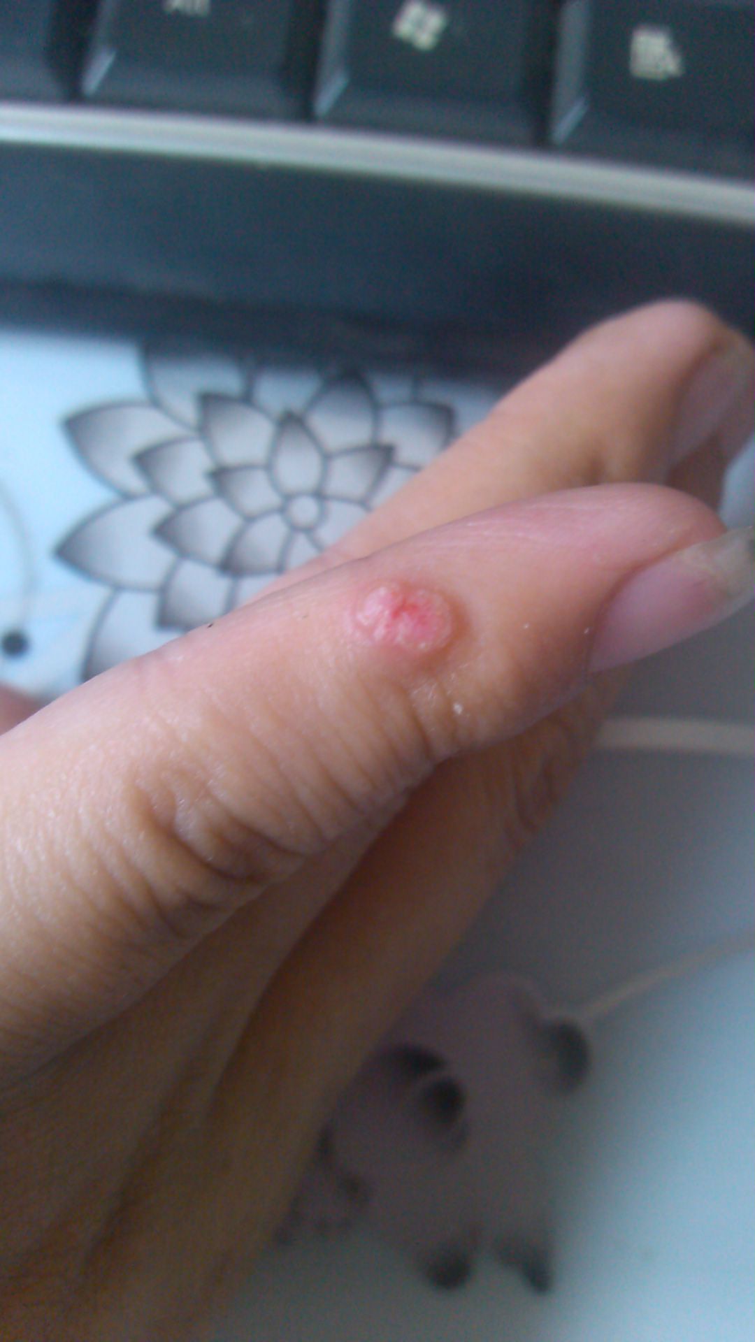 刺猴 几年了 来个亲身经历的可以么