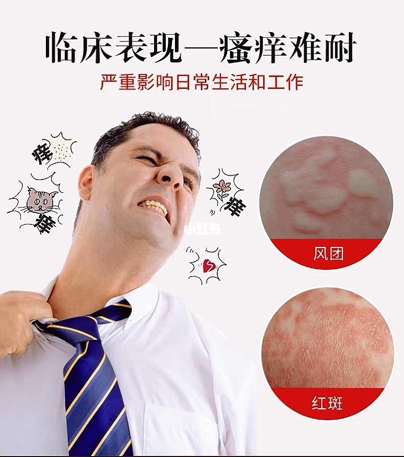 荨麻疹风疹化妆品过敏紫外线过敏物理过敏