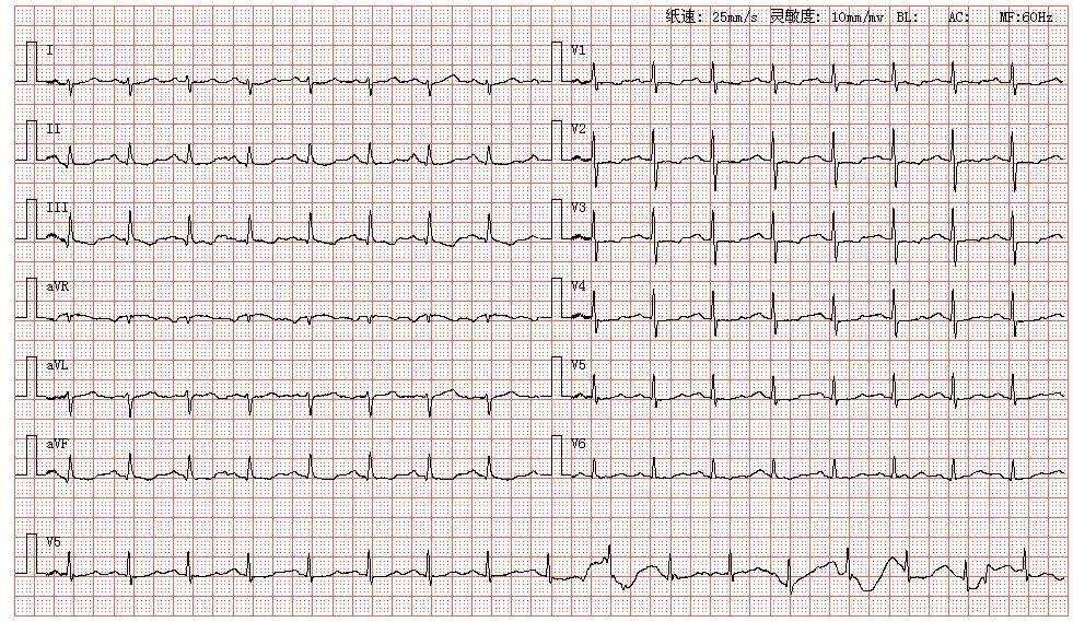 院,图为其心电图结论:窦性心律左后分支传导阻滞v1r/s>1st-t异常分析