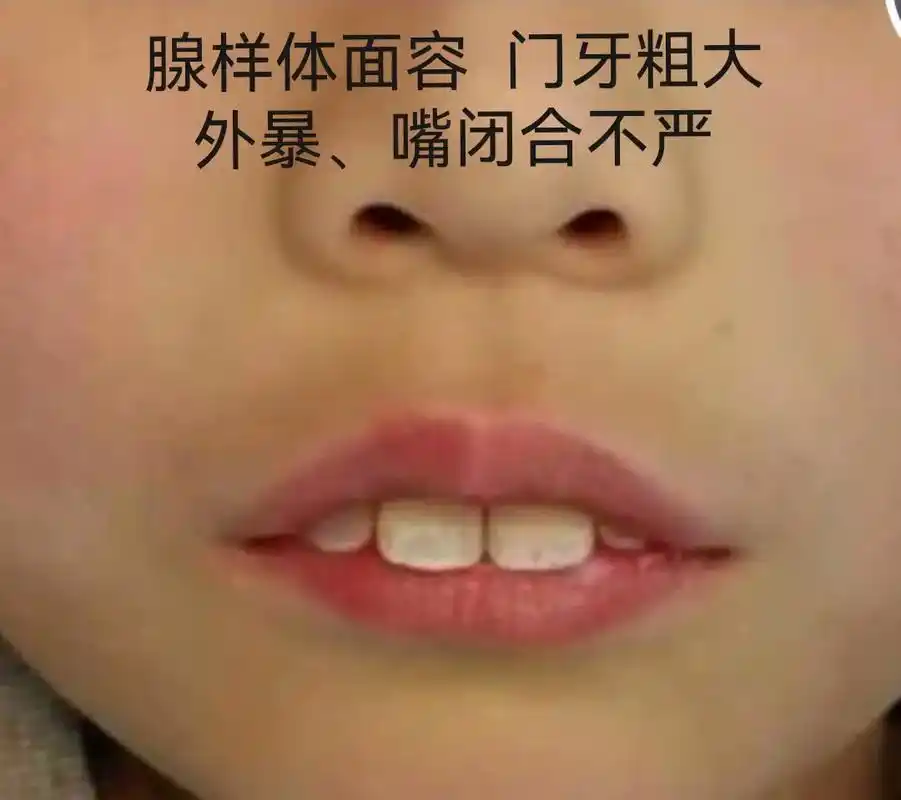 健康才醉美#腺样体肥大#鼻炎#扁桃体肥大#中医养生 - 抖音