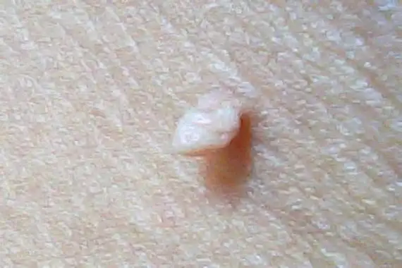 为体积较小,褐色,黑色或肤色的突起物,称为皮赘,皮赘也称为皮肤赘生物