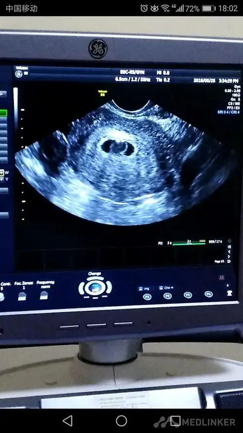 诊断 处理发病以来,未用药,二便正常,无腹痛随访 讨论停经43天,阴道不