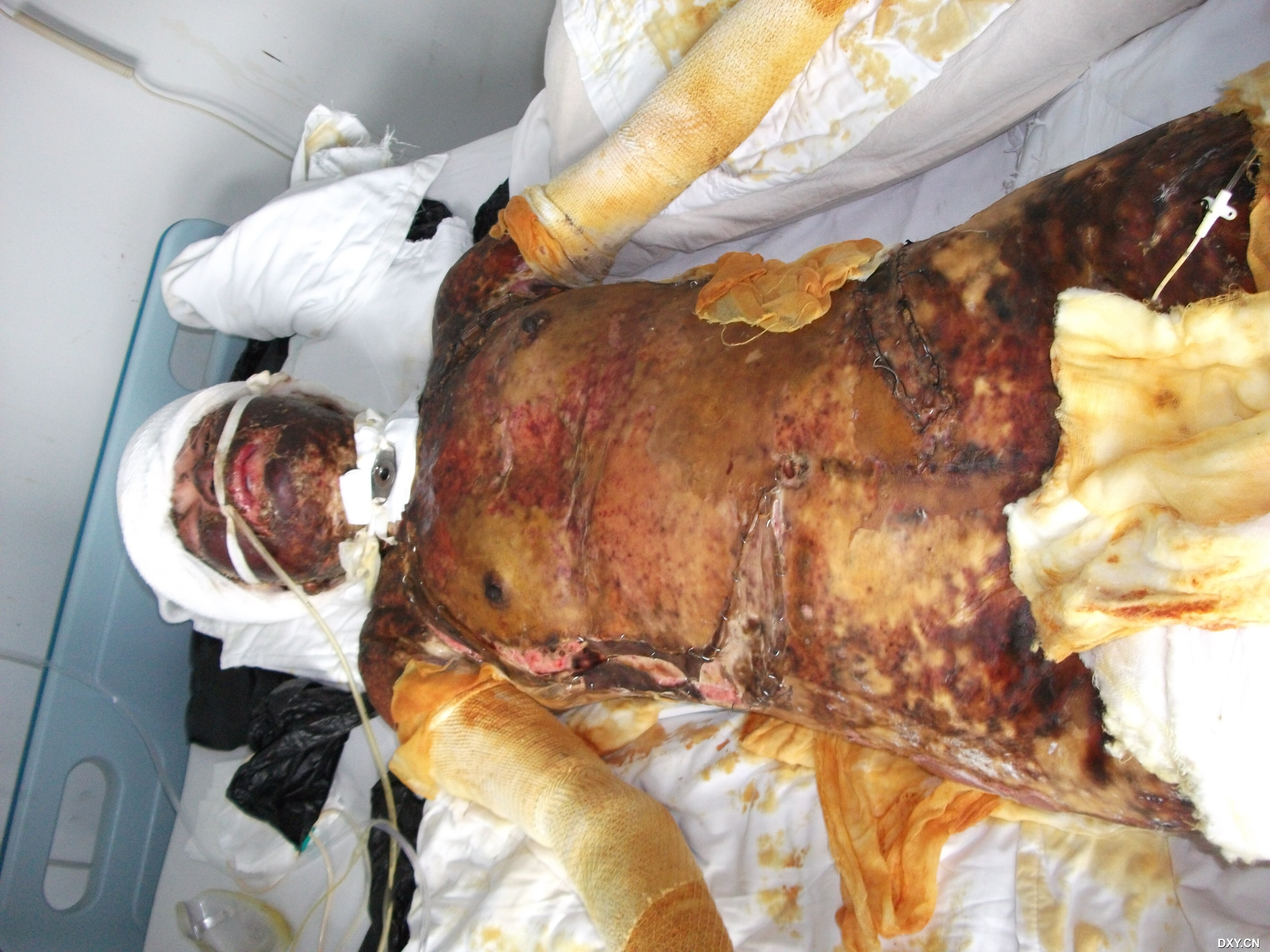 【讨论】特重度烧伤95%,三度 [精华] [病例帖]