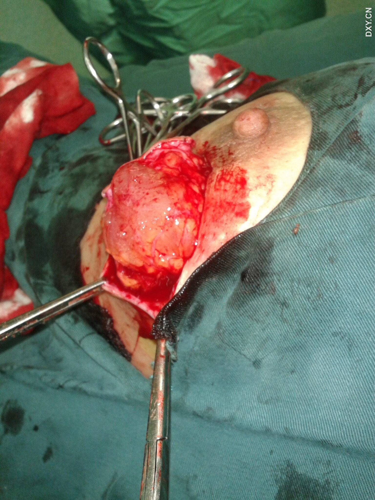 【求助】昨天下午做的一乳房肿块,切开却是…… [病例帖]