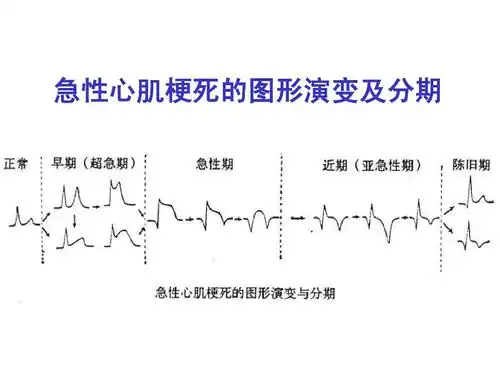 心电图 演示文稿2 急性心肌梗死的图形演变及分期