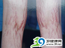 皮肤紫纹