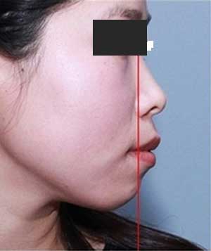 嘴巴突出来侧脸很难看?突嘴如何判断?怎么治疗?