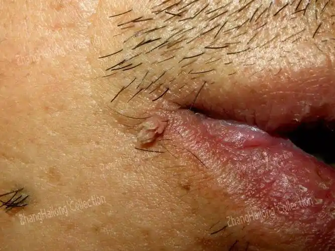 痦子是怎么形成的瘊子是怎么形成的